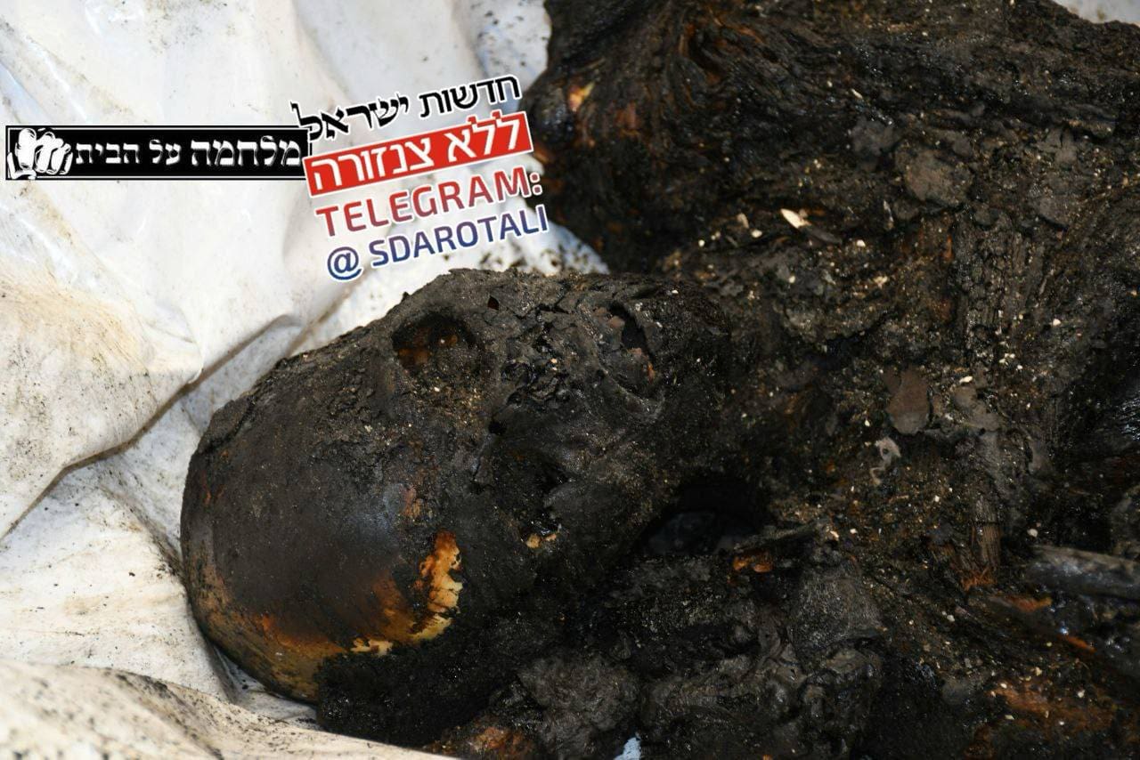 Child burned by Hamas